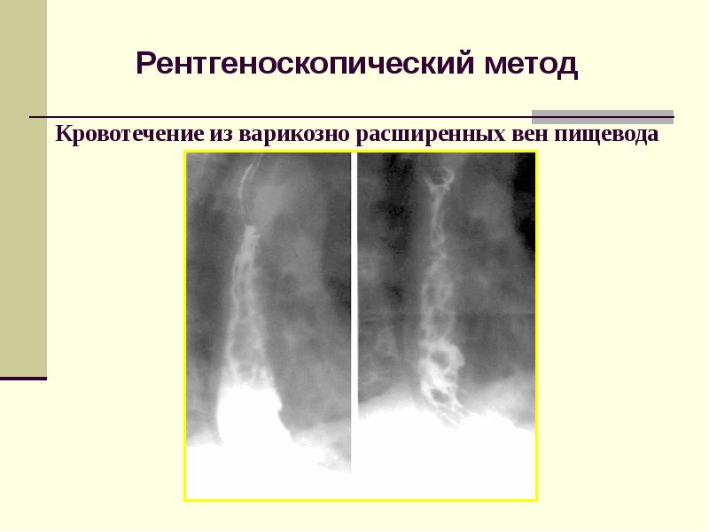 Варикозное Расширение Пищевода 2 Степени