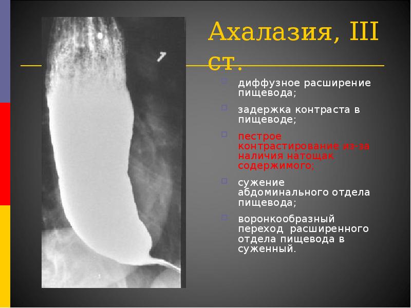 Варикозное Расширение Пищевода 1 Степень