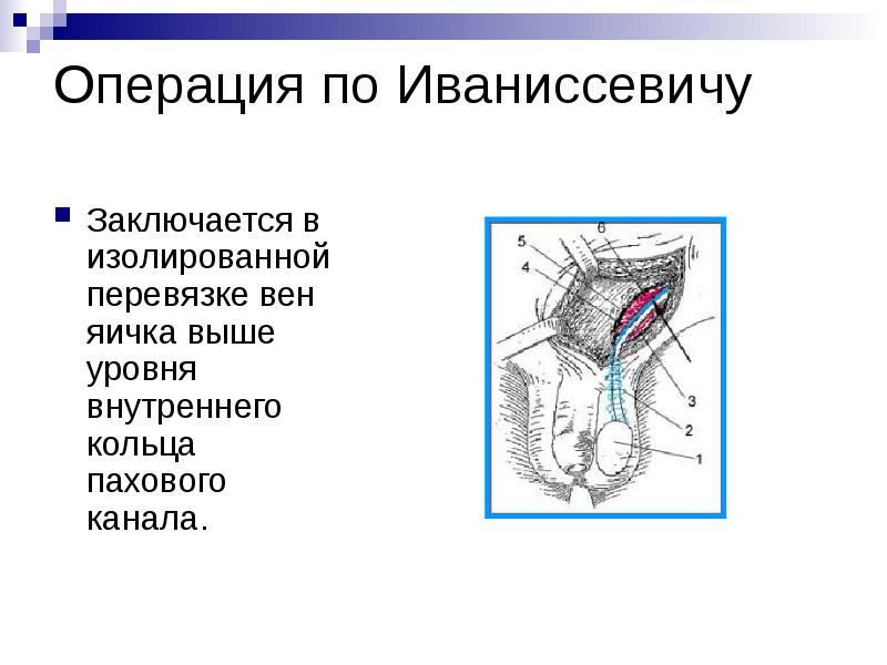 Варикозное Расширение Вен Семенного Канатика Лечение