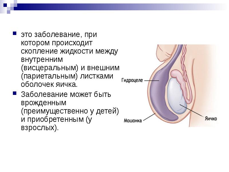 Расширение Вен Семенного Канатика