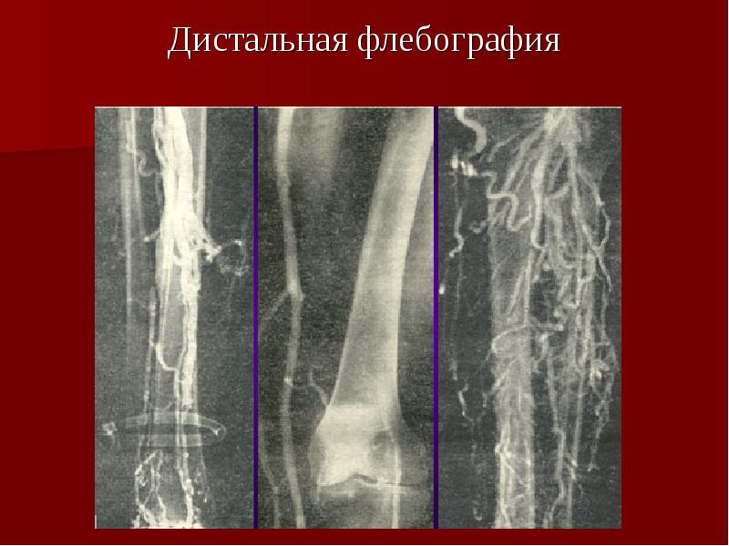 Варикоз Ppt Онлайн