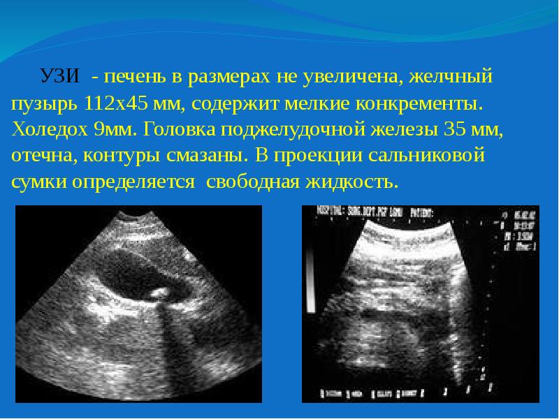 Диаметр Селезеночной Вены 8 Мм