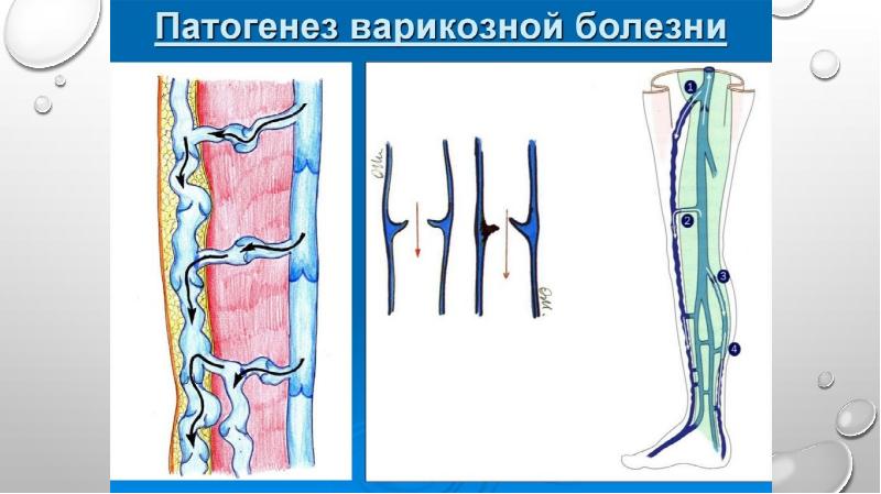 Презентация На Тему Варикозное Расширение Вен Нижних Конечностей