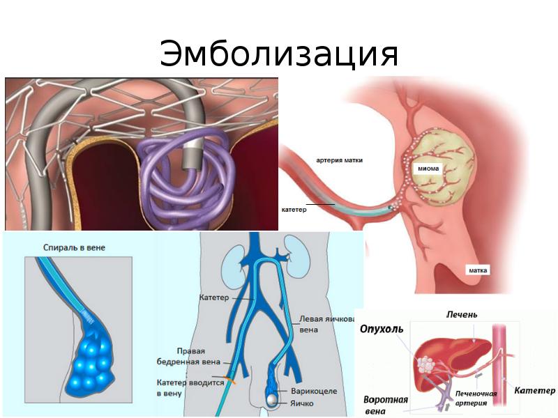 Варикоз На Матке Цена