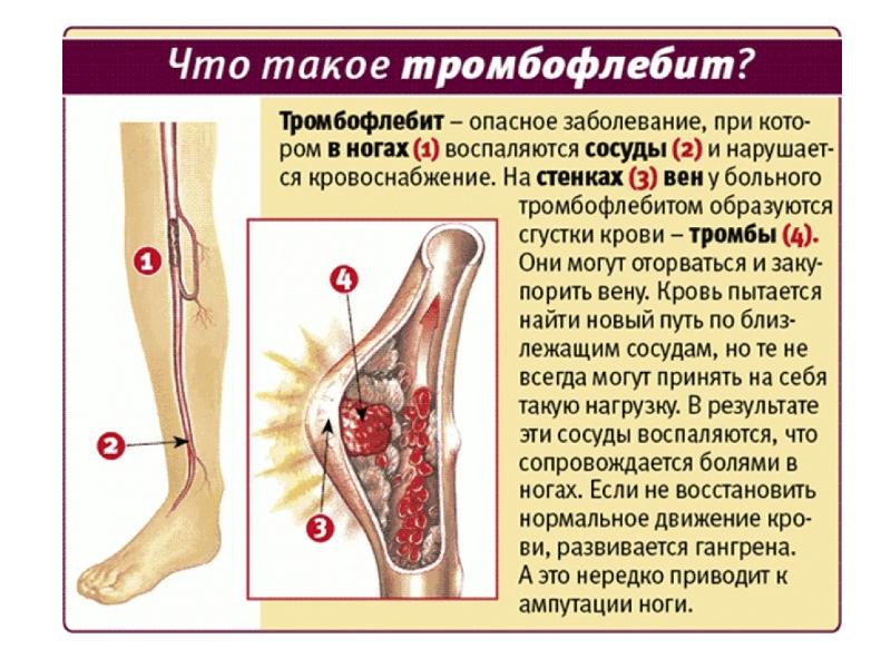 Варикоз Нижних Конечностей Определение