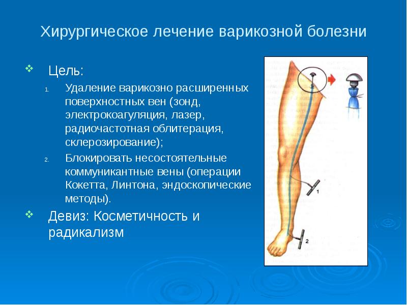 Варикоз Хирургическое