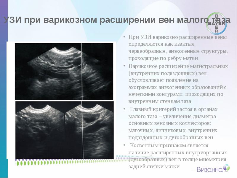 Вены Аркуатного Сплетения