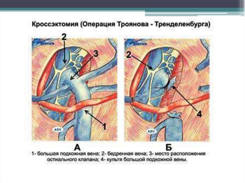 Вены Хирургическим Путем