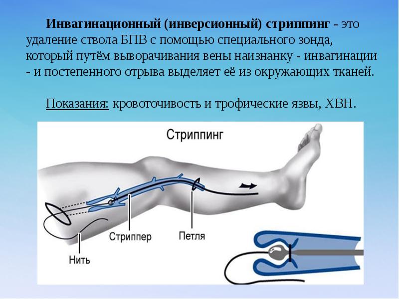 Вены Хирургическим Путем