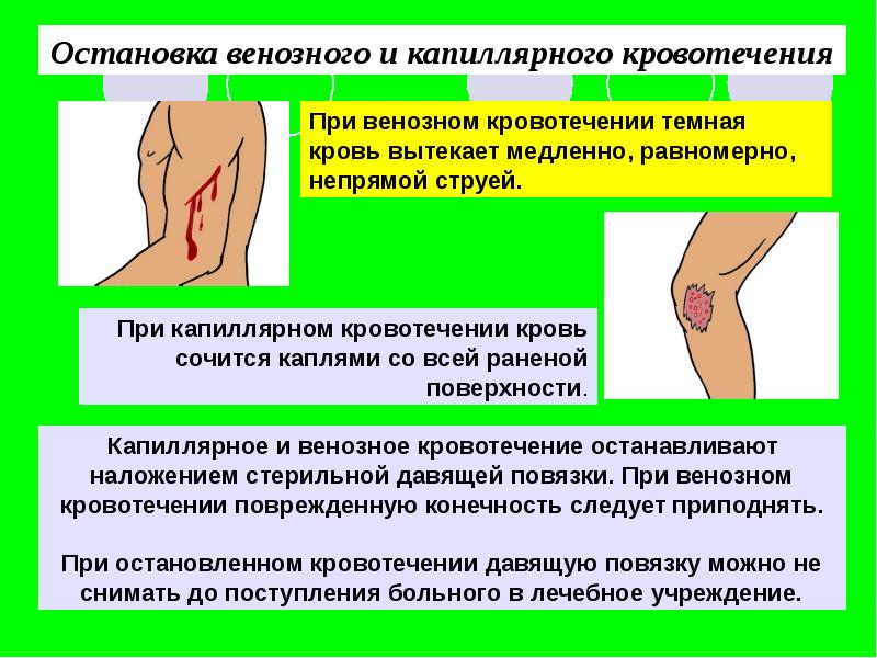 Варикозное Кровотечение Первая Помощь