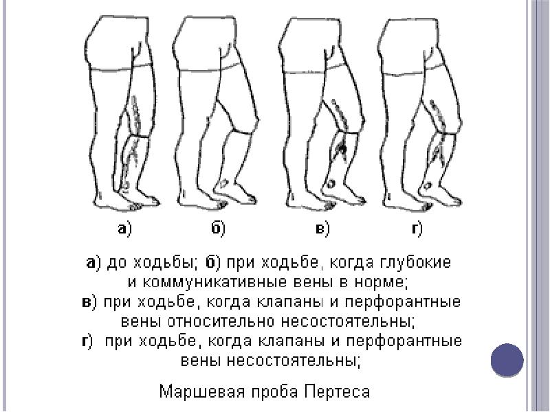 Варикоз Ходьба