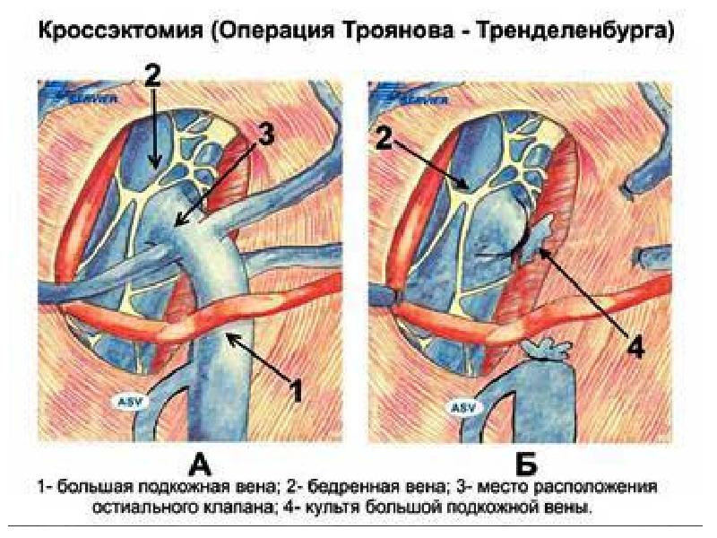 Варикоз Хирургическое Лечение Отзывы