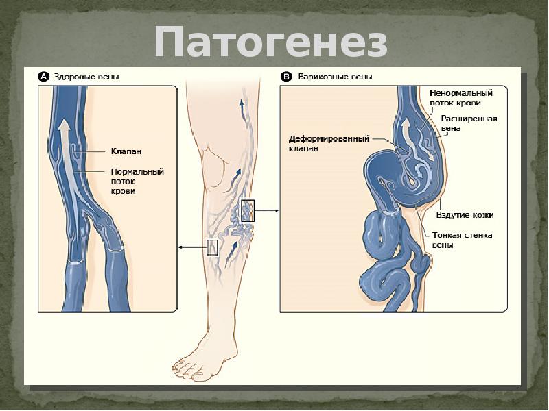 Варикоз Емі