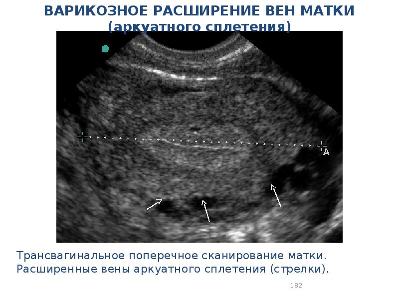 Узи Малого Таза Варикозное Расширение