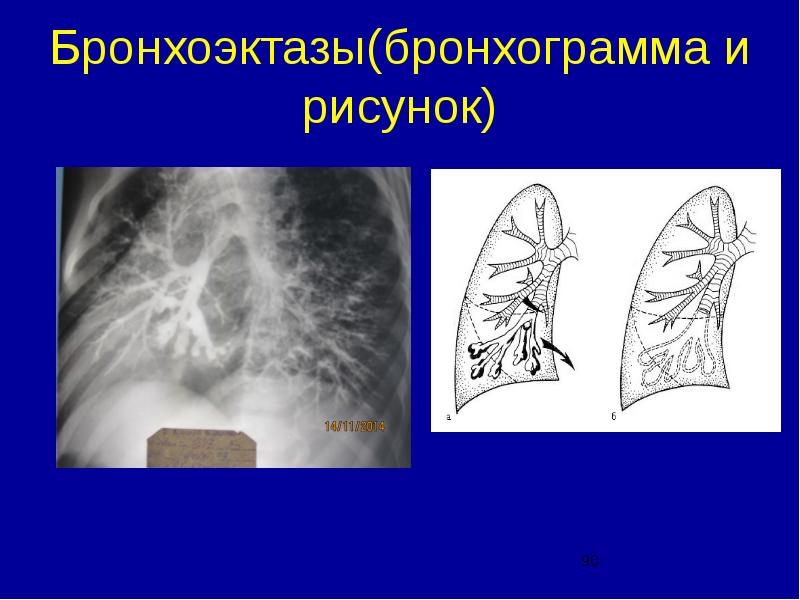 Варикозные Бронхоэктазы