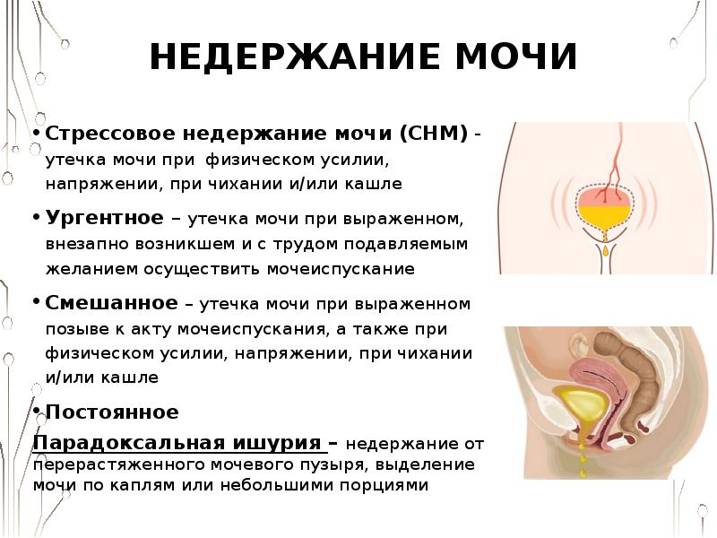 Мочевой Пузырь Во Время Секса