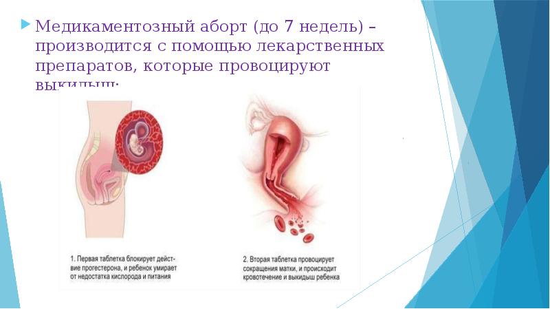 Аборт у гинеколога - 39 видео. Смотреть аборт у гинеколога - порно видео на lavandasport.ru