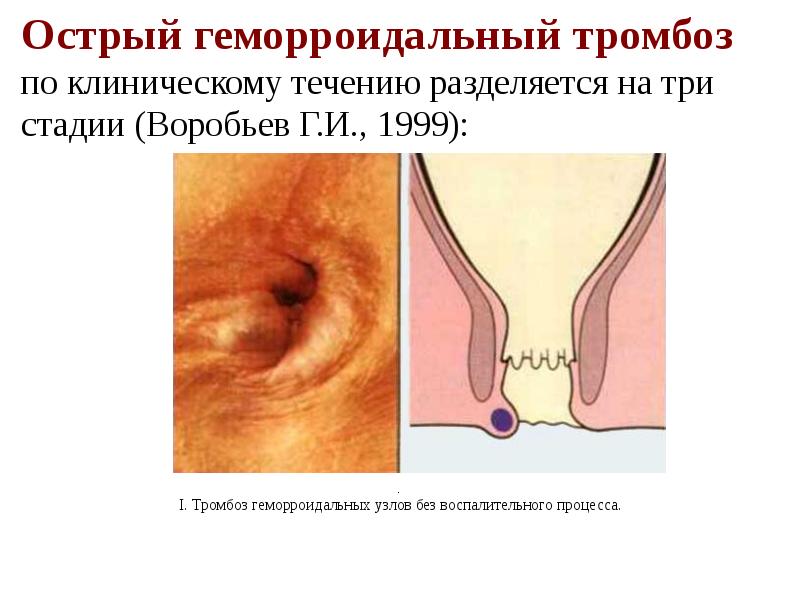 Выпадение Кишки После Анального Секса