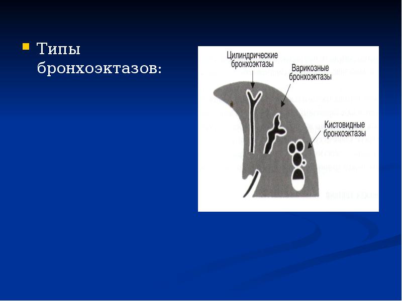 Варикозные Бронхоэктазы