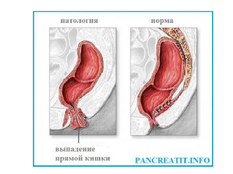Выпадение Кишки После Анального Секса