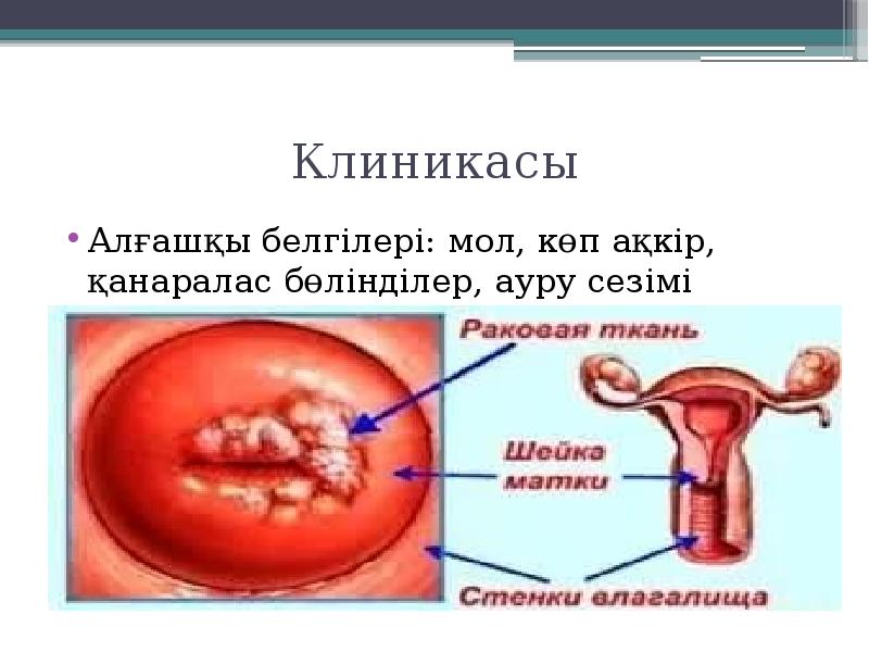 Варикоз Ауруы ?Аза?Ша Зарубежный Аралас