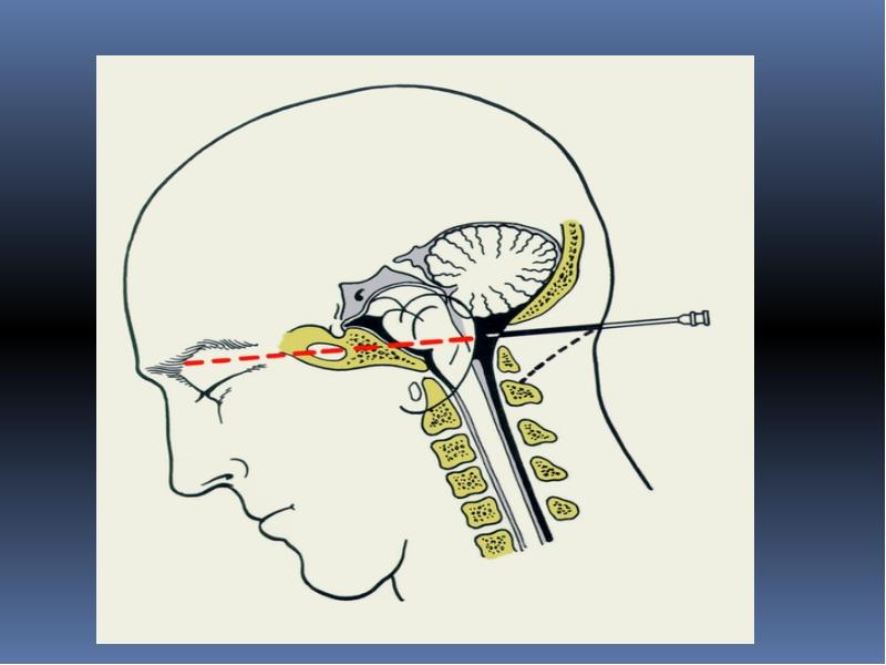Пункция мозга. Субокципитальная пункция. Спинномозговая пункция субокципитальная. Субокципитальный прокол. Субокципитальная пункция техника.