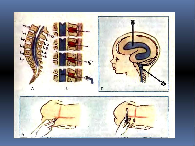 Пункция мозга. Пункции вентрикулярная субокципитальная. Люмбальная и субокципитальная пункция. Спинномозговая пункция субокципитальная. Субокципитальное Введение.