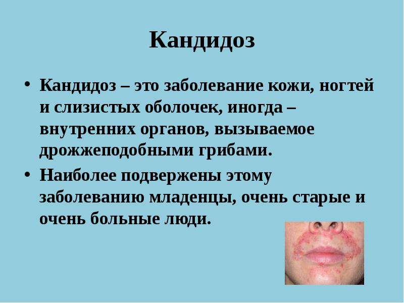 Кандидоз
Кандидоз – это заболевание кожи, ногтей и слизистых оболочек, иногда Кандидоз
Кандидоз – это заболевание кожи, ногтей и слизистых оболочек, иногда