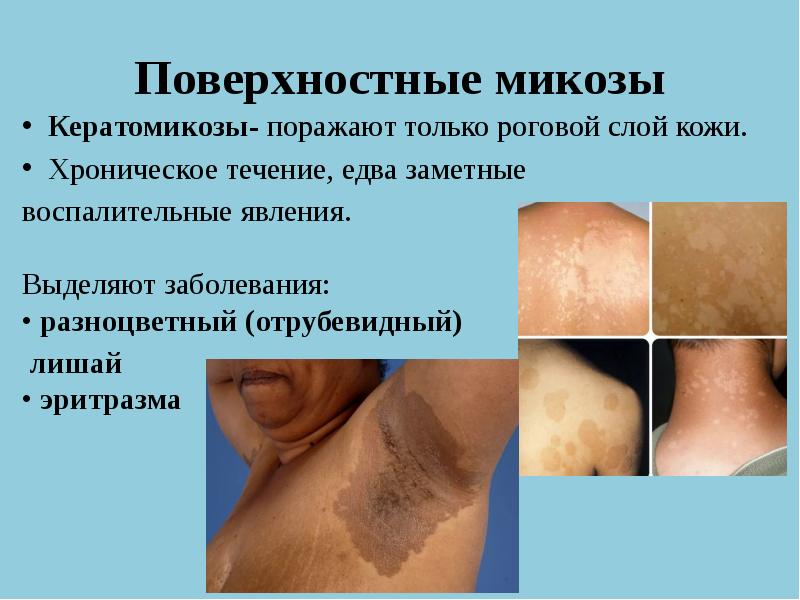 Поверхностные микозы
Кератомикозы- поражают только роговой слой кожи.
Хроническое течение, едва Поверхностные микозы
Кератомикозы- поражают только роговой слой кожи.
Хроническое течение, едва