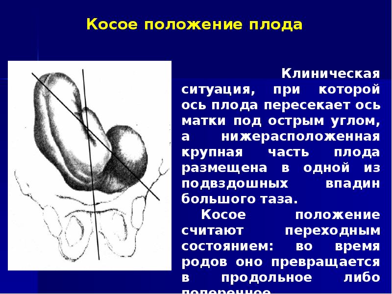 Косое и поперечное положение плода презентация