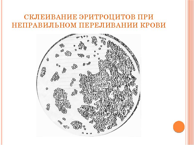 Склеивание эритроцитов при неправильном переливании крови Склеивание эритроцитов при неправильном переливании крови