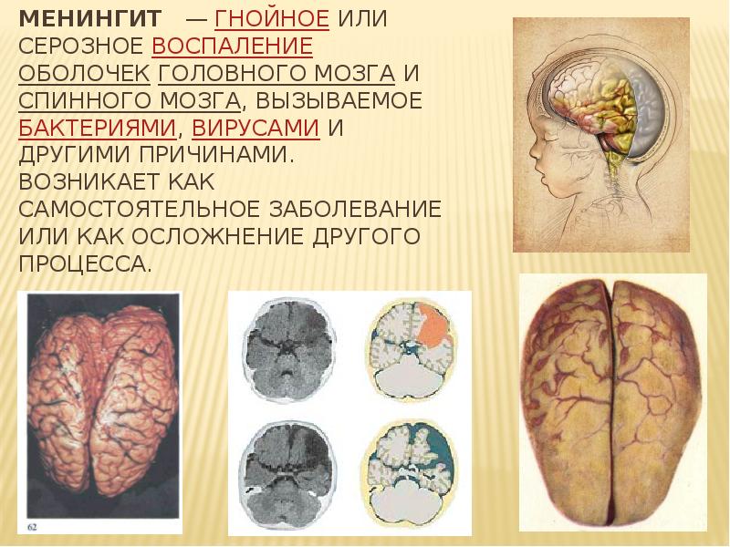 Менингококковый менингит презентация