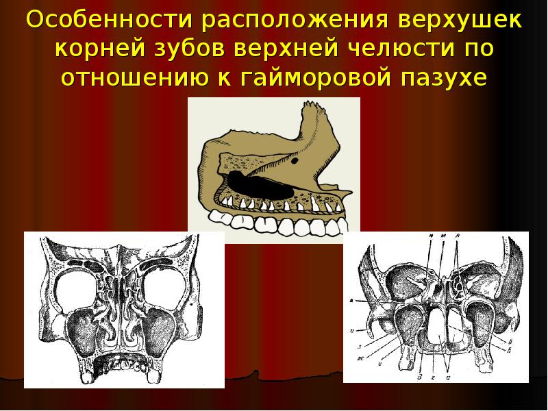 Особенности расположения верхушек корней зубов верхней челюсти по отношению к гайморовой