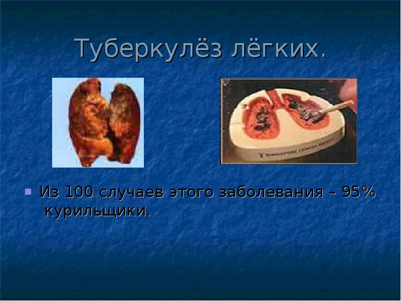 Туберкулёз лёгких.
Из 100 случаев этого заболевания – 95% курильщики. Туберкулёз лёгких.
Из 100 случаев этого заболевания – 95% курильщики.