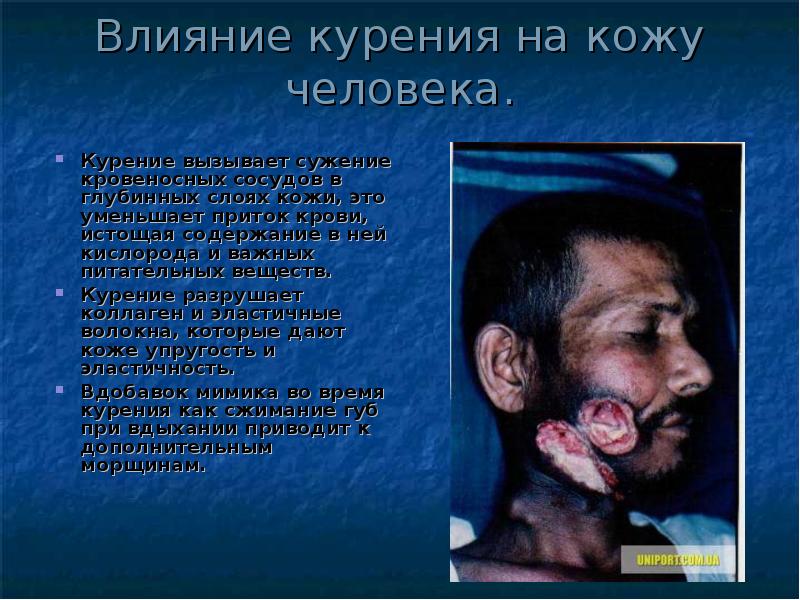 Влияние курения на кожу человека.
Курение вызывает сужение кровеносных сосудов Влияние курения на кожу человека.
Курение вызывает сужение кровеносных сосудов