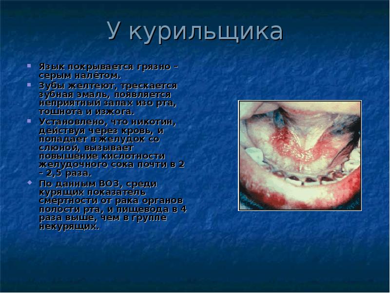 У курильщика
Язык покрывается грязно – серым налётом.
Зубы желтеют, трескается У курильщика
Язык покрывается грязно – серым налётом.
Зубы желтеют, трескается