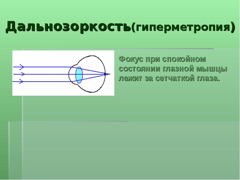 Гиперметропия глаза. Гиперметропия. Дальнозоркость корректируется. Гиперметропия презентация. Классификация дальнозоркости.