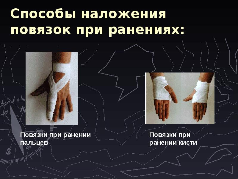 Способы наложения повязок при ранениях:
