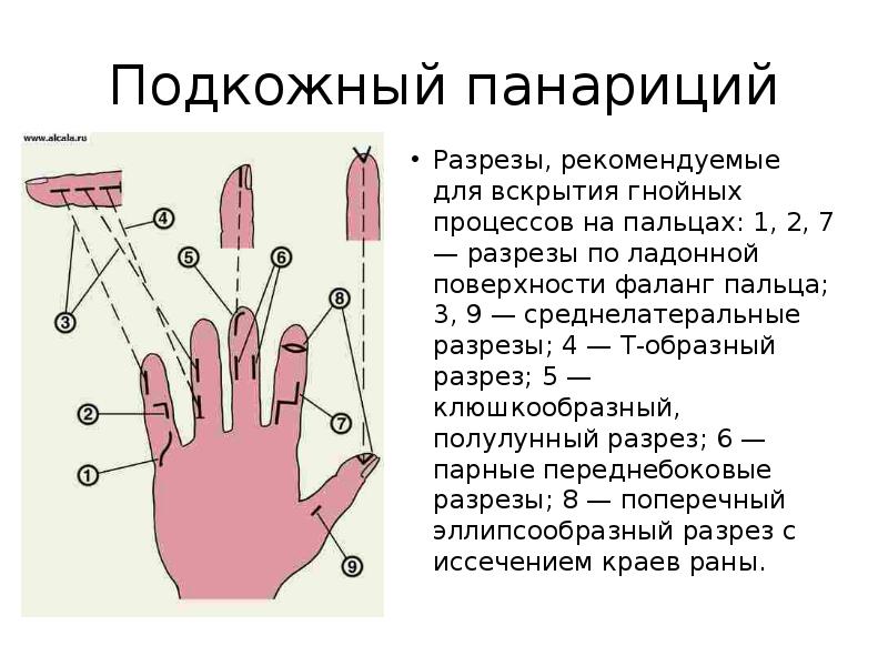 Рана пальца кисти код по мкб 10. Подкожный панариций 1 пальца. Панариций мизинца кисти. Суставной панариций разрезы.