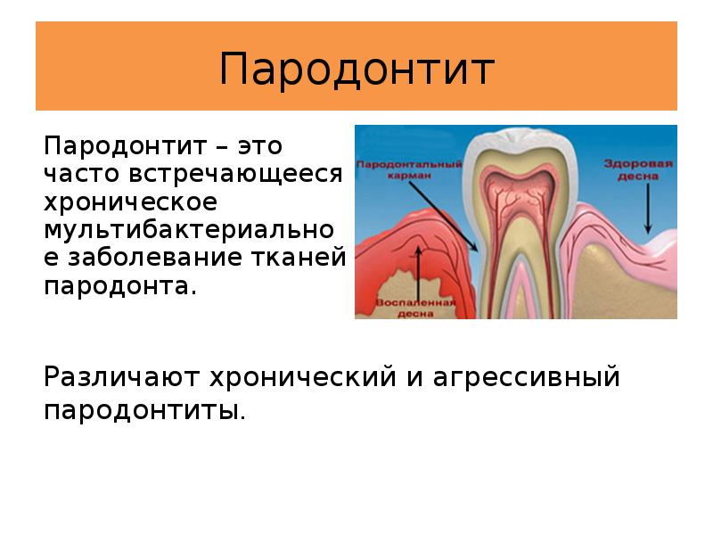 Профилактика заболеваний пародонта презентация