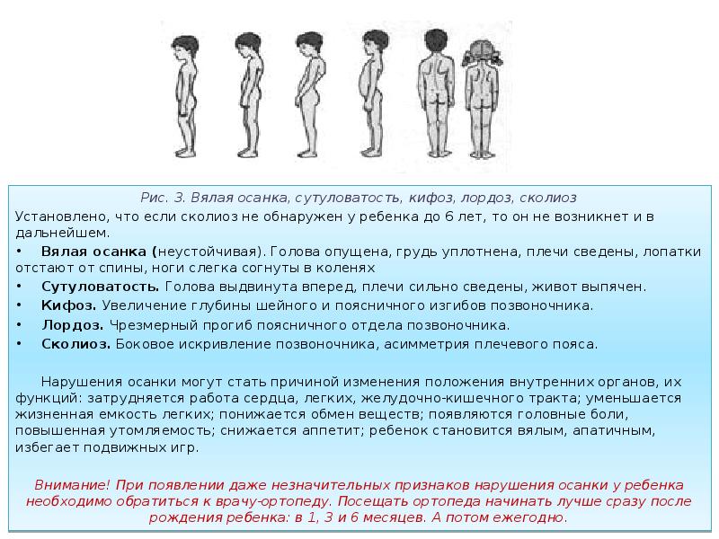 Нарушение осанки и причины их возникновения обж 5 класс презентация