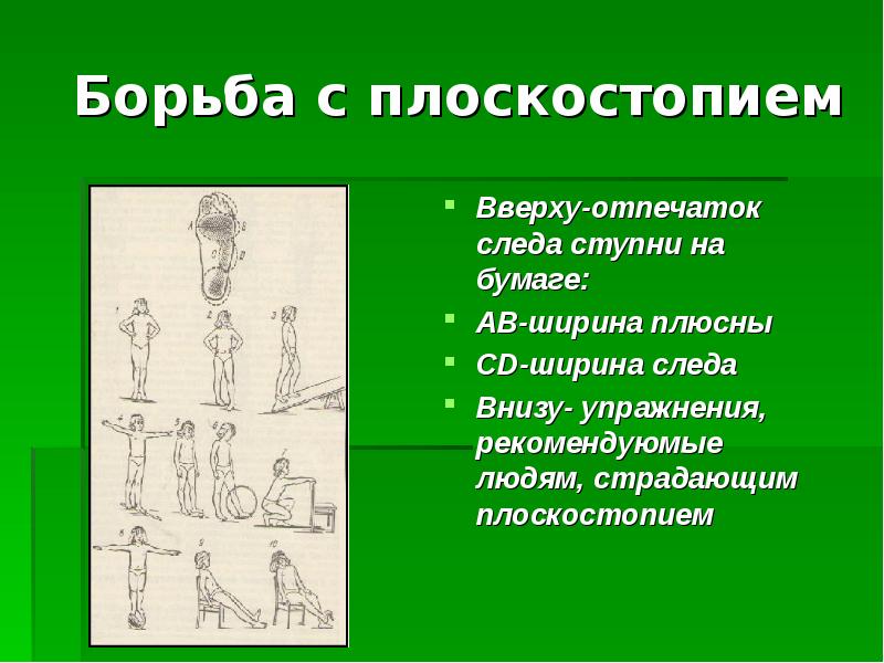 Проект на тему плоскостопие