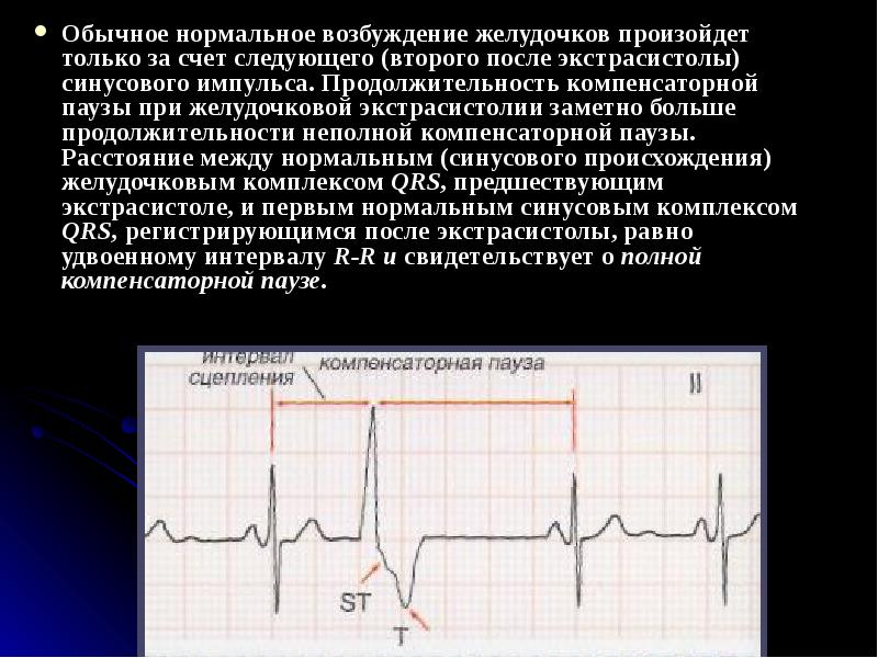 Нормальной обычной. Наджелудочковая экстрасистолия неполная компенсаторная пауза. Желудочковая экстрасистола компенсаторная пауза. Экстрасистолия полная и неполная компенсаторная пауза. Компенсаторная пауза при желудочковой экстрасистолии.