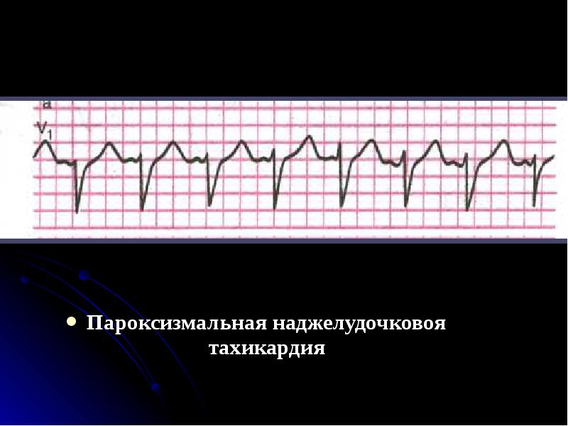 Тахикардия ночью. Пароксизмальная тахикардия. Пароксизмальная тахикардия мкб. Пароксизмальная тахикардия у собак. Не пароксизмальная тахикардия.