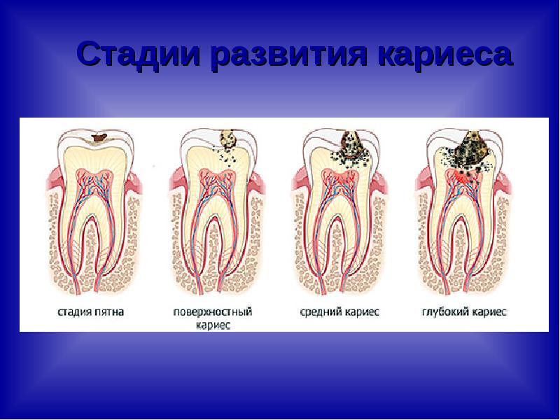 Стадии кариеса картинки