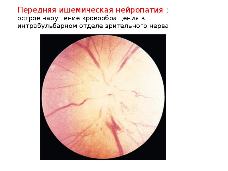 Нейропатия зрительных. Передняя ишемическая нейропатия глазное дно. Ишемическая нейропатия сетчатки. Оптическая нейропатия зрительного нерва. Неврит зрительного нерва.