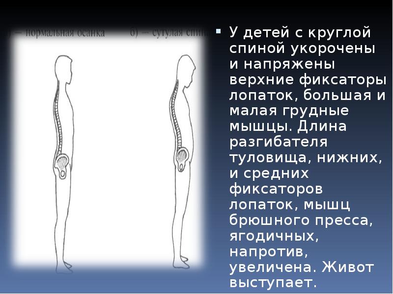 Мышцы осанки. Круглая спина презентация. Мышцы Верхние фиксаторы лопаток. Плоская спина осанка мышцы. Укорочение разгибателей спины.