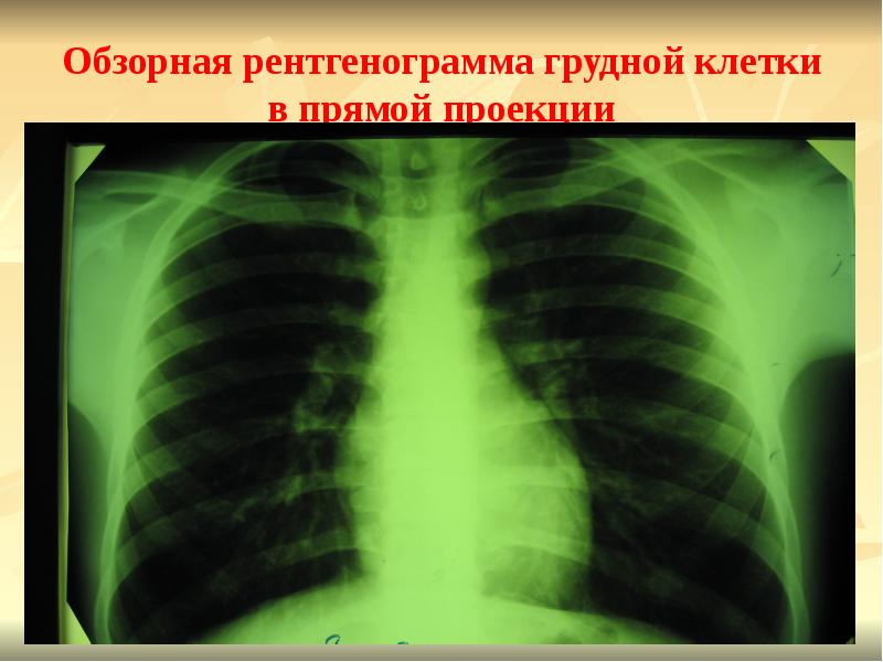 Обзорная рентгенограмма грудной клетки в прямой проекции