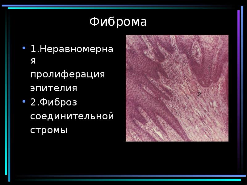 Доброкачественная ткань. Доброкачественная опухоль соединительной тканной. Злокачественная опухоль из эпителия.