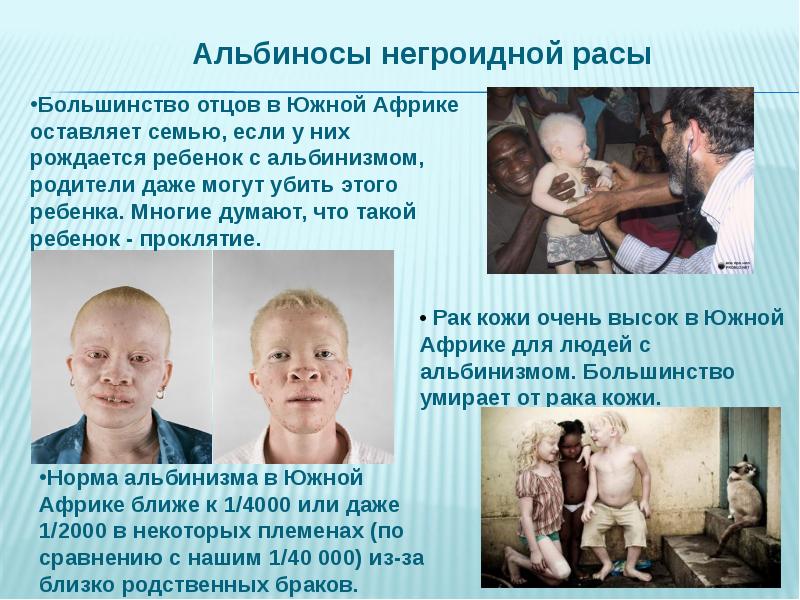 Презентация про альбинизм